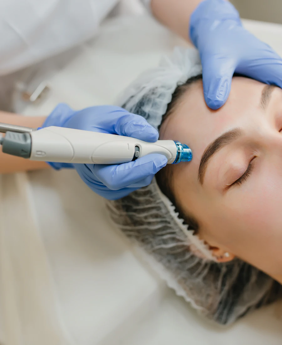 Microneedling treatment